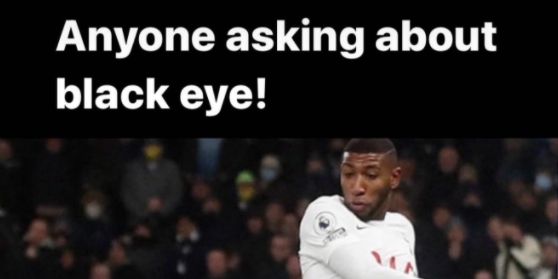 (Image) ‘This might help’ – Andy Robertson uploads image to explain how he sustained his black eye