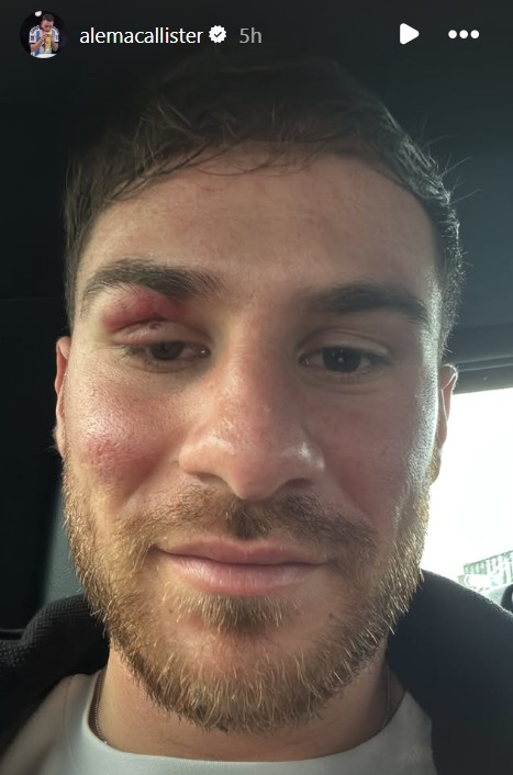 Alexis Mac Allister was left with a black eye and swollen cheek after colliding with Omar Marmoush